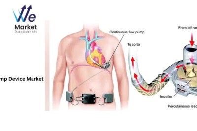 Heart Pump Device Market Trends and Innovations: 2024–2033