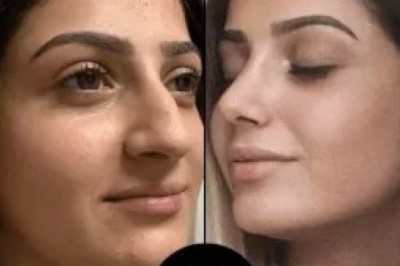 PRP Treatment in Dubai with PerfectDrs: Safe, Effective, and Trusted Results