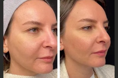 Best Aesthetic Clinics in Dubai Offering Mesotherapy for Under-Eye Bags