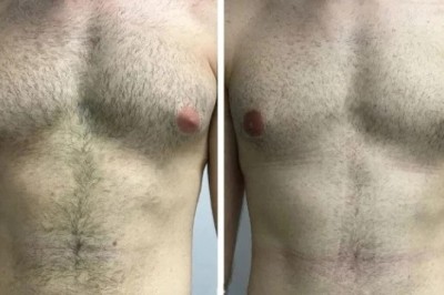 Gynecomastia Surgery in Dubai for Athletes: What to Know