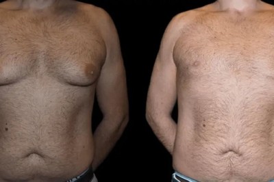 Gynecomastia Surgery Results in Dubai: Transform Your Chest