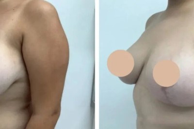 Lollipop Breast Lift in Dubai: Balanced and Beautiful