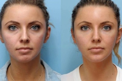 Thread Lift Performed by Best Doctors in Dubai Restores Natural Confidence Gracefully