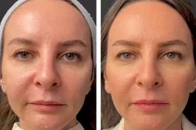 Best Aesthetic Clinic in Dubai Highlights Mesotherapy for Natural Beauty