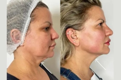 Best Aesthetic Clinics in Dubai for Dermal Fillers