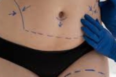 Professional Liposuction Surgery in Istanbul: Benefits, Process, and Why BEST MED TURKEY is Your Top Choice