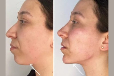 Rejuvenate Your Appearance with Endolift from the Best Plastic Surgeons in Dubai