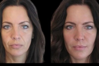 Jawline Sculpting with Best Plastic Surgeon in Dubai: Non-Surgical Solutions for Jawline Fillers