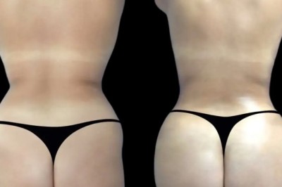 Hyacorp Fillers Treatments in Dubai: Quick and Effective