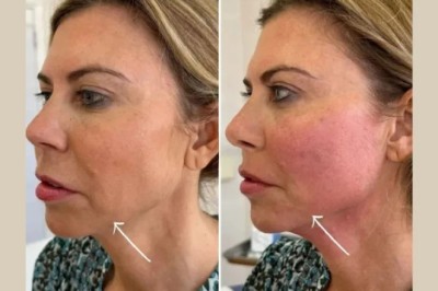 Your Complete Guide to Endolift by the Best Aesthetic Clinic in Dubai