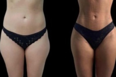 Experience Advanced Rejuvenation with J-Plasma Skin Tightening Treatment in Dubai