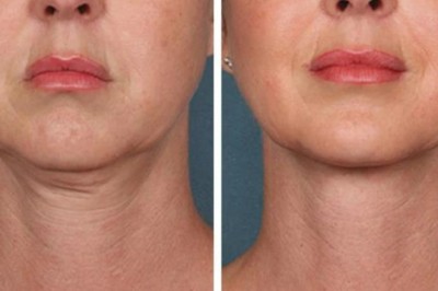 Laser Hair Removal Treatment in Dubai: Safe, Fast, and Effective Solution