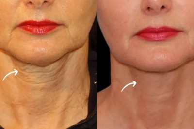 Best Aesthetic Clinic in Dubai: Sculptra for Wrinkles