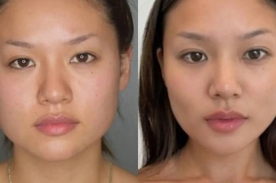 Future of Non-Invasive Options by the Best Buccal Fat Removal Surgeon in Dubai