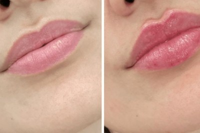 How to Prepare for Juvederm in Dubai