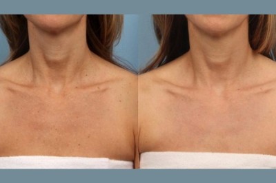 Everything You Need to Know about Moxi Laser Treatment at the Best Aesthetic Clinic in dubai