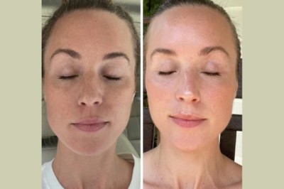 Wrinkle Reduction at the Best Aesthetic Clinic in Dubai Fotona 4D Laser