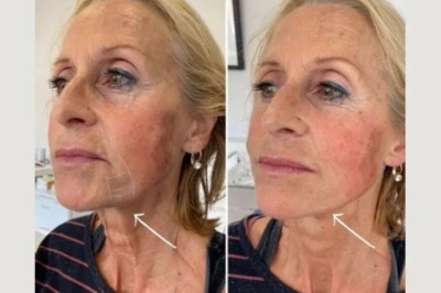 Endolift Treatment in Dubai for Reducing Wrinkles and Fine Lines