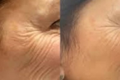 Embrace Skin Smooth Beauty with the Profhilo by Best Plastic Surgeons in dubai