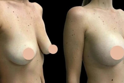 Breast Augmentation in Dubai: Combining Surgery with a Breast Lift
