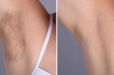 Laser hair removal Treatment in Dubai for Smooth Confidence