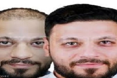 💇‍♂️ الفرق بين زراعة الشعر الطبيعي والاصطناعي في الرياض