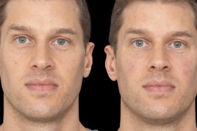 Best Doctors in dubai Explain the Science Behind Under Eye Fillers Formation