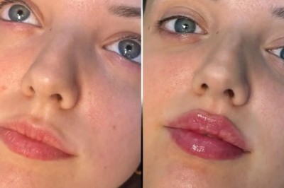 Choosing the Best Doctors in Dubai for Fillers What to Consider