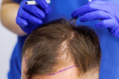 زراعة الشعر في الرياض: استعادة مظهرك الطبيعي بثقة