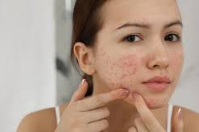 Acne Treatment in Dubai: Advanced Laser and Medical Solutions