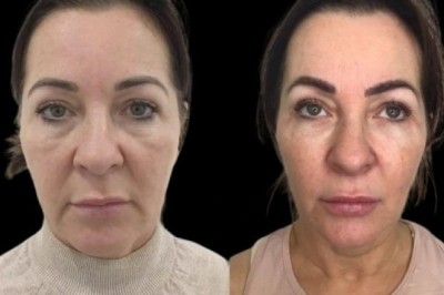 Step into radiance with Profhilo by the Best Plastic Surgeon in dubai