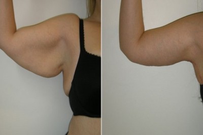 هل عملية شد الذراعين في الرياض مناسبة لك؟