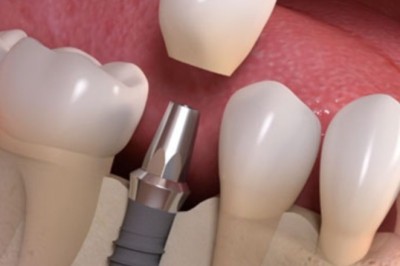 How Immediate Load Implants Work for Patients in Dubai