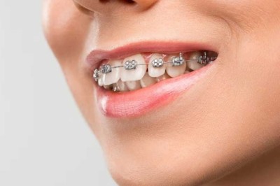 Orthodontics in Dubai: Treatment Options for a Healthier Smile