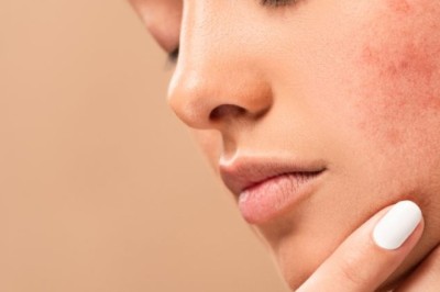 Acne Treatment in Dubai: Safe and Effective Methods for All Ages