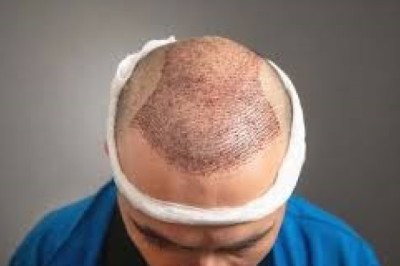زراعة الشعر للصلع الكامل في الرياض: هل استعادة الكثافة ممكنة؟