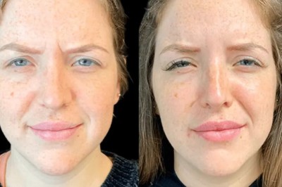 Is Botox Safe? Expert Insights on Botox Treatment in Dubai