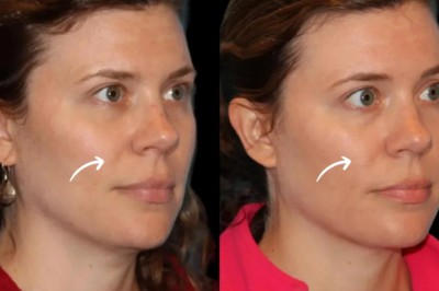 Best Doctors in Dubai for Sculptra Eye Fix