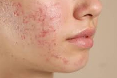 Acne Treatment in Dubai: Myths and Facts You Should Know