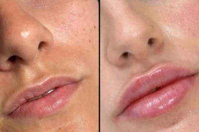 Chin Enhancement with Fillers at Best Aesthetic Clinic in Dubai