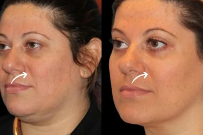 Best Plastic Surgeon in Dubai on Sculptra Texture