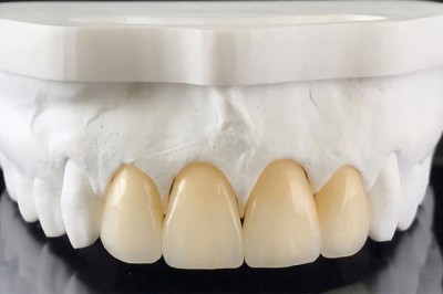 Dental Crowns and Bridges Dubai for Long-Lasting Results
