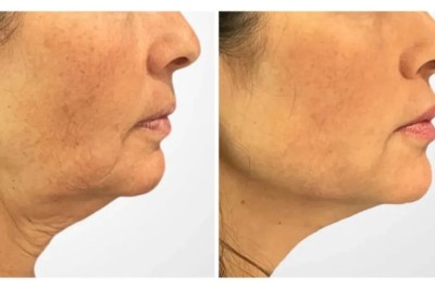 Best Doctors in Dubai Specializing Thread Lift for Natural Facelift Results