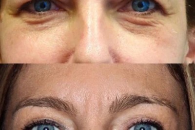 Blepharoplasty in Dubai for Droopy Eyelids: How It Improves Vision and Appearance