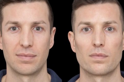 How to Maintain Your Jawline Fillers: Best Doctors in Dubai Tips