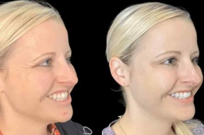 Reduce Expression Lines with Expert Botox Treatments in Dubai