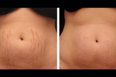 Visible Skin Tightening with Radiofrequency (RF) Microneedling Treatment in Dubai