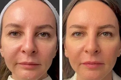 Mesotherapy in Dubai vs Other Skin Treatments: Key Differences