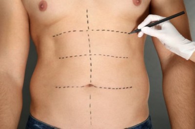 سر الرشاقة الدائمة: تجارب شفط الدهون في الرياض قبل وبعد