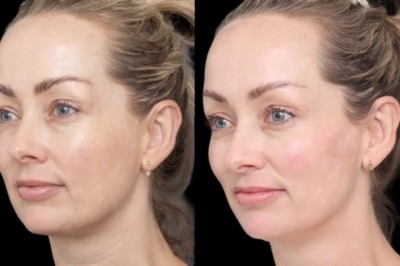 Best Plastic Surgeon in Dubai on Personalized Under Eye Fillers Plans